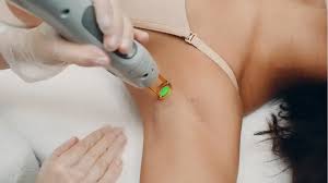 Ultimate Laser Hair Removal Tips: A Complete Guide